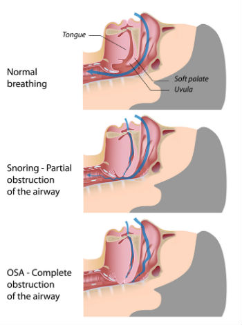 Sudden gasp for 2025 air while sleeping