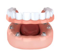 Implant-Dentures