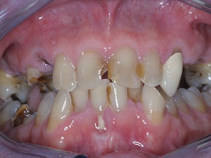 Before Dental Implants Treatment