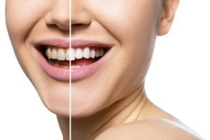 Teeth Whitening Services