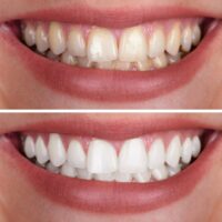 When Should You Consider a Complete Smile Makeover?