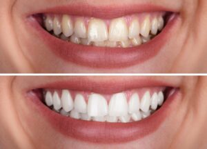 When Should You Consider a Complete Smile Makeover?